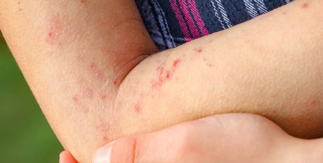 Dermatitis atópica, una enfermedad que estigmatiza a niños y adultos