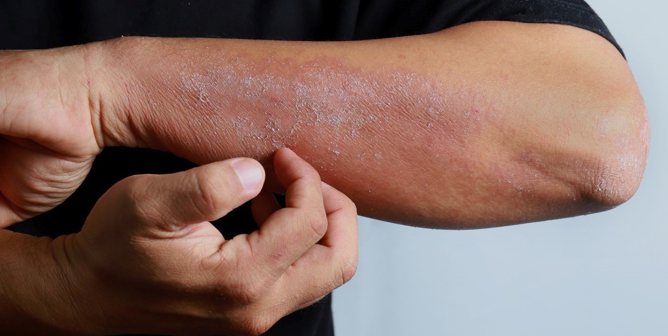 Campaña nacional de detección gratuita de dermatitis atópica: dónde consultar