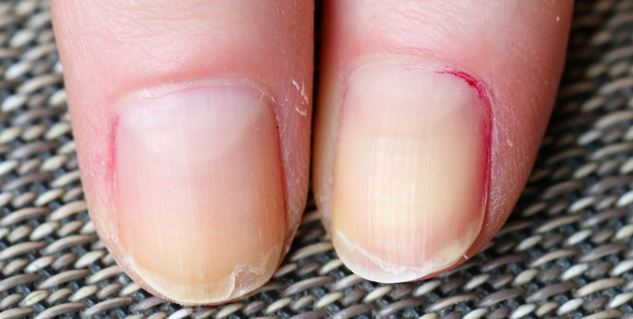 Uñas descamadas: por qué ocurre y qué dicen sobre tu salud