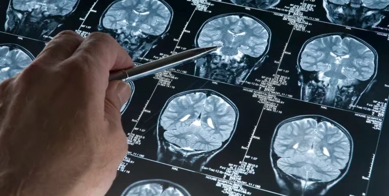 Científicos de la UBA investigan cómo detectar el Alzheimer con inteligencia artificial