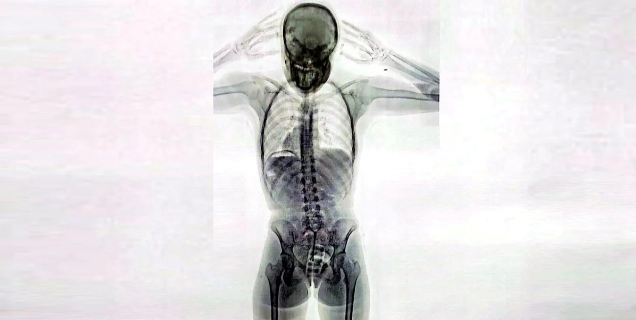 Impresionante imagen de un escáner de rayos X: una mula tenía 78 cápsulas de cocaína en el cuerpo
