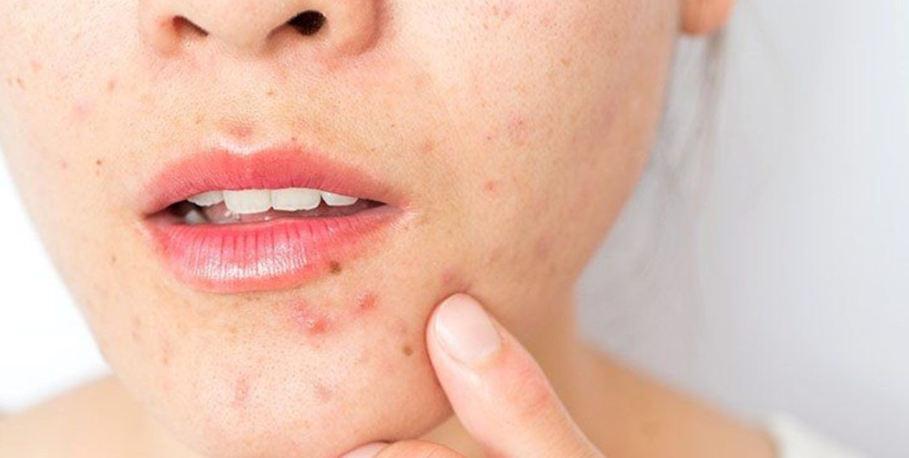 Cómo deshacerse de los granitos sin dañar la piel