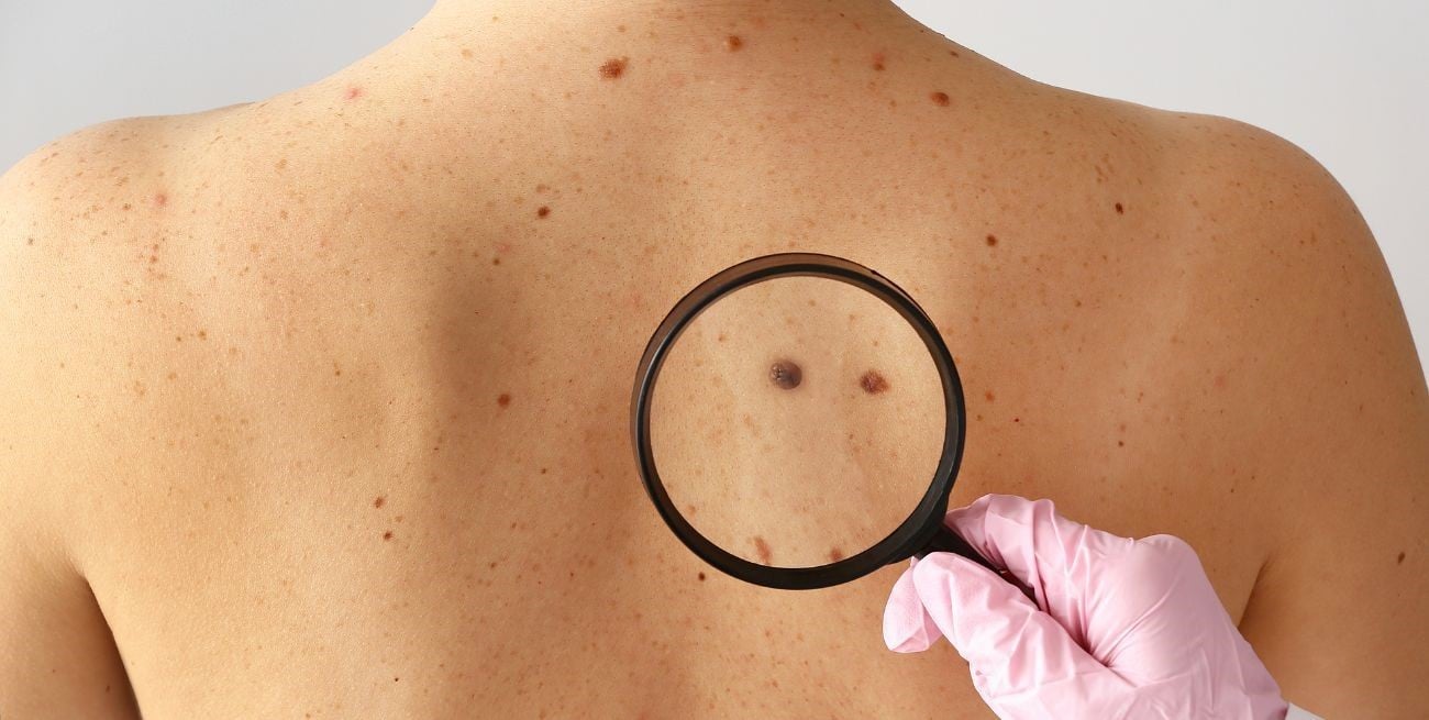 Dermatólogos chequearán lunares de manera gratuita para concientizar sobre el cáncer de piel