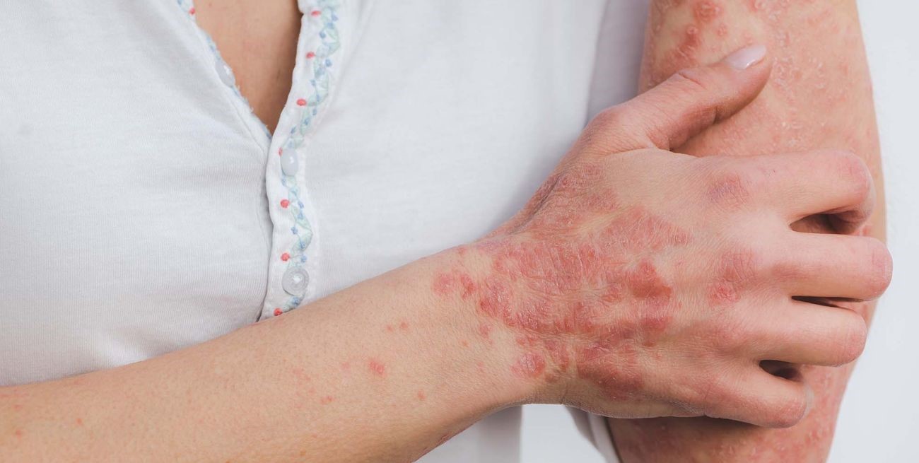 Este lunes y el jueves se realiza una campaña de detección de psoriasis y artritis psoriásica