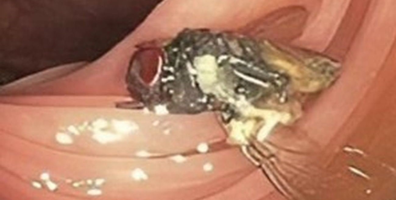 Hallaron una mosca intacta dentro de un paciente durante una colonoscopía 