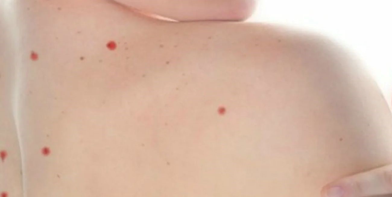 Por qué aparecen lunares rojos en la piel: ¿son peligrosos?