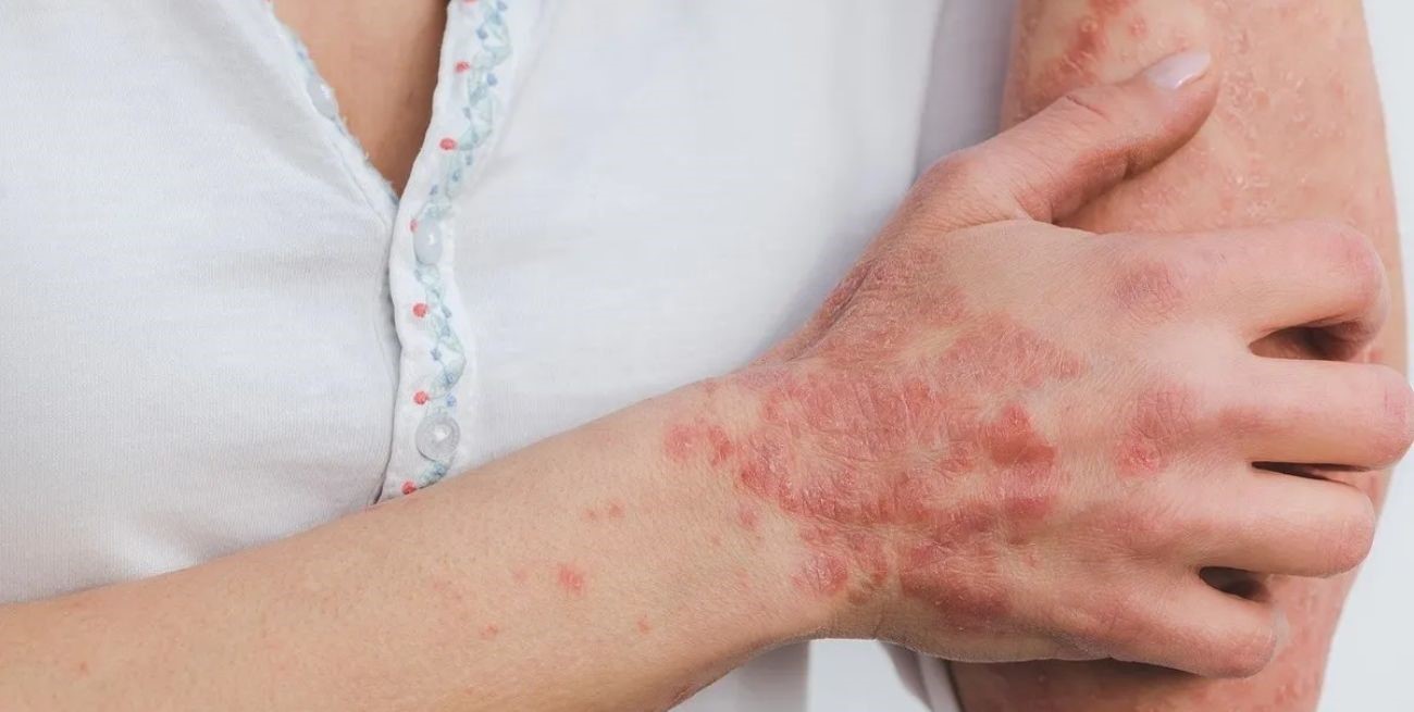 La OMS alertó sobre enfermedades con "consecuencias devastadoras": cuáles están presentes en Argentina