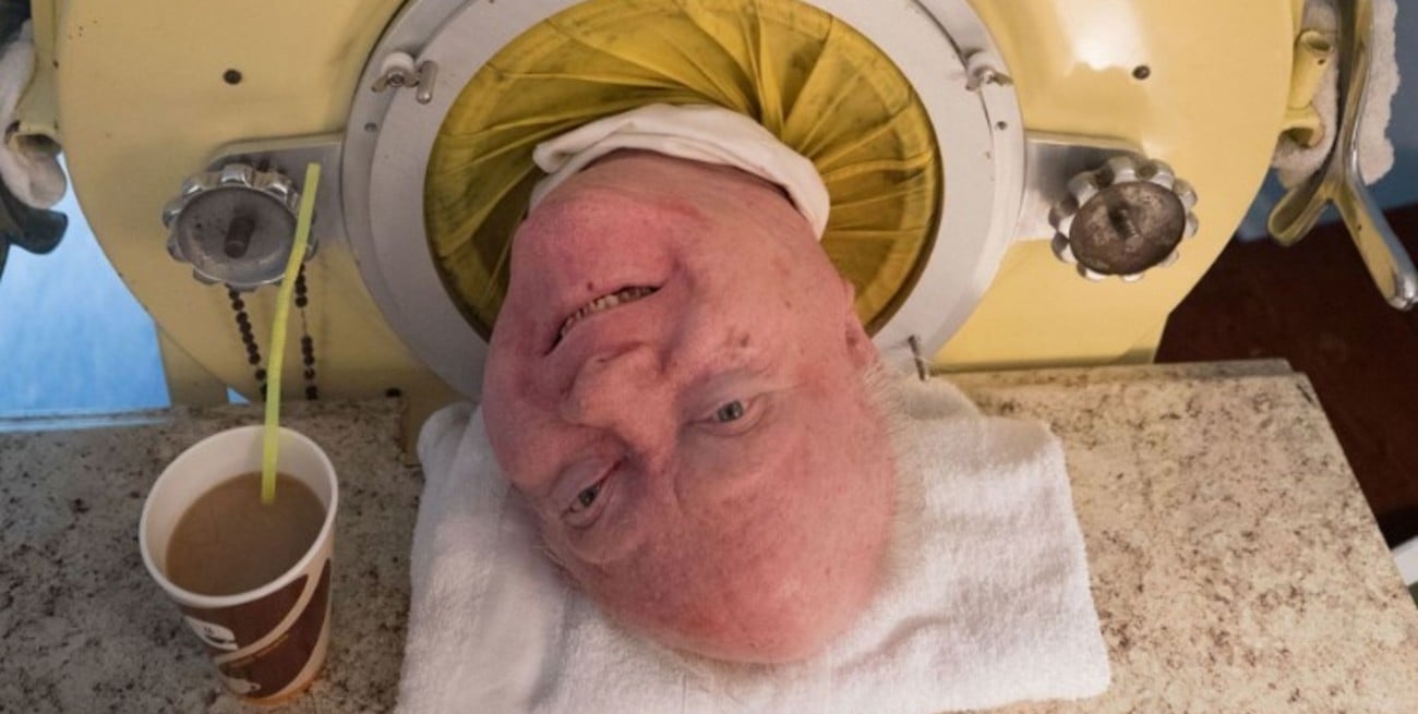 Murió Paul Alexander, el hombre que vivió 70 años en un pulmón de acero