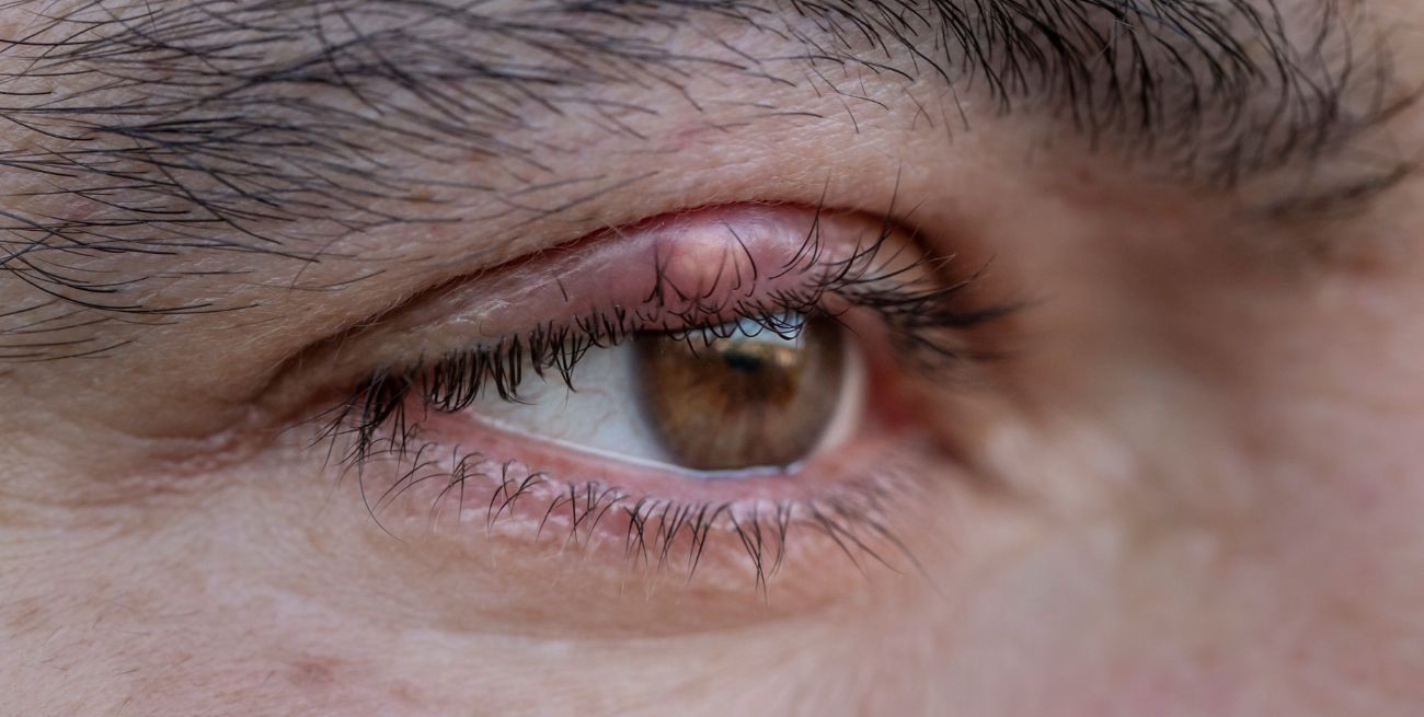 Qué hacer si tenés un orzuelo: guía completa con recomendaciones