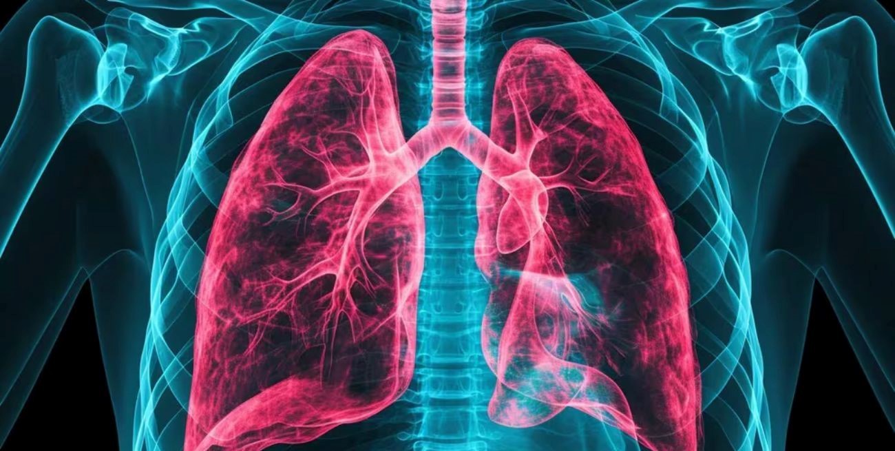 Aumento de casos de neumonías agudas graves en Argentina ¿Cuál es la causa?