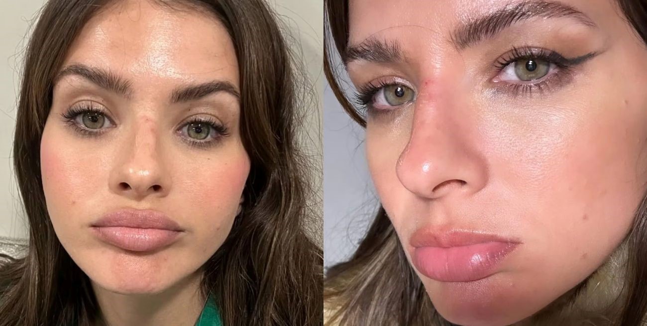 La China Suárez se fracturó la nariz y mostró las secuelas en sus redes