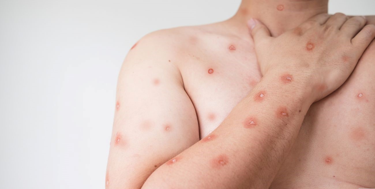 Viruela del Mono: el Ministerio de Salud actualizó la situación en Santa Fe