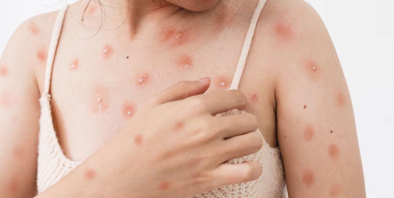 Viruela del Mono: síntomas, cómo se contagia y qué se debe hacer en caso de contraerla