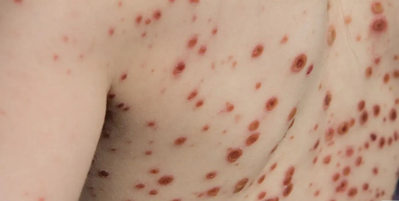 Situación de la viruela del mono en Argentina: en qué provincias se registraron casos