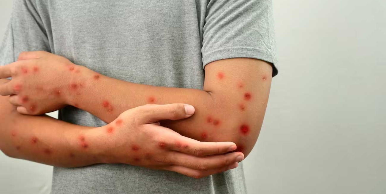 Murió el cordobés que se contagió viruela de mono en México