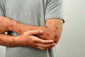 El joven tenía 28 años y contrajo el virus en el país azteca, donde permanecía internado.