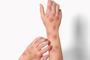 Según el último informe publicado por el Ministerio de Salud, en la última semana se registraron 11 nuevos casos.