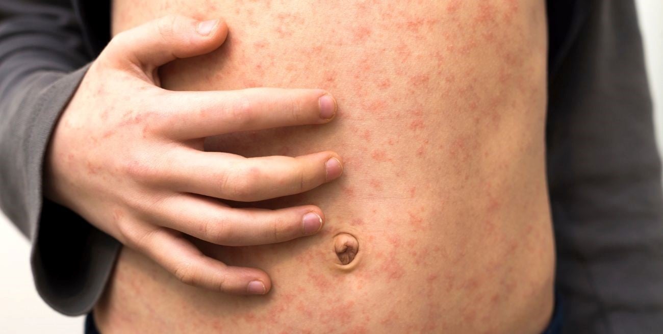 Chile declaró el alerta por sarampión ante el aumento de casos en Argentina