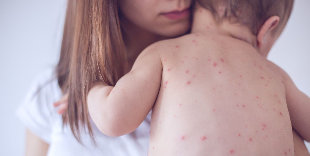 Sarampión: Rosario refuerza la vacunación ante casos registrados en otras provincias