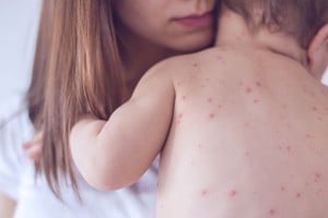 El sarampión es una enfermedad viral altamente contagiosa y puede presentar complicaciones graves, especialmente en niños pequeños y personas con defensas bajas.