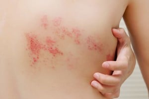 Se manifiesta principalmente en la piel con lesiones dolorosas,