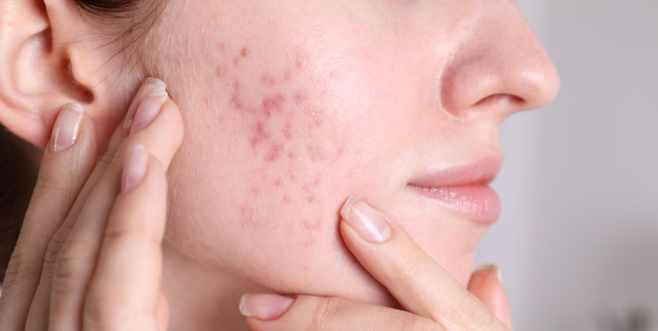 Acné en la adultez: causas, tratamientos y consejos 