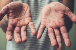 La diputada santafesina Drisun criticó la falta de respuesta de Nación ante brote de sarampión.