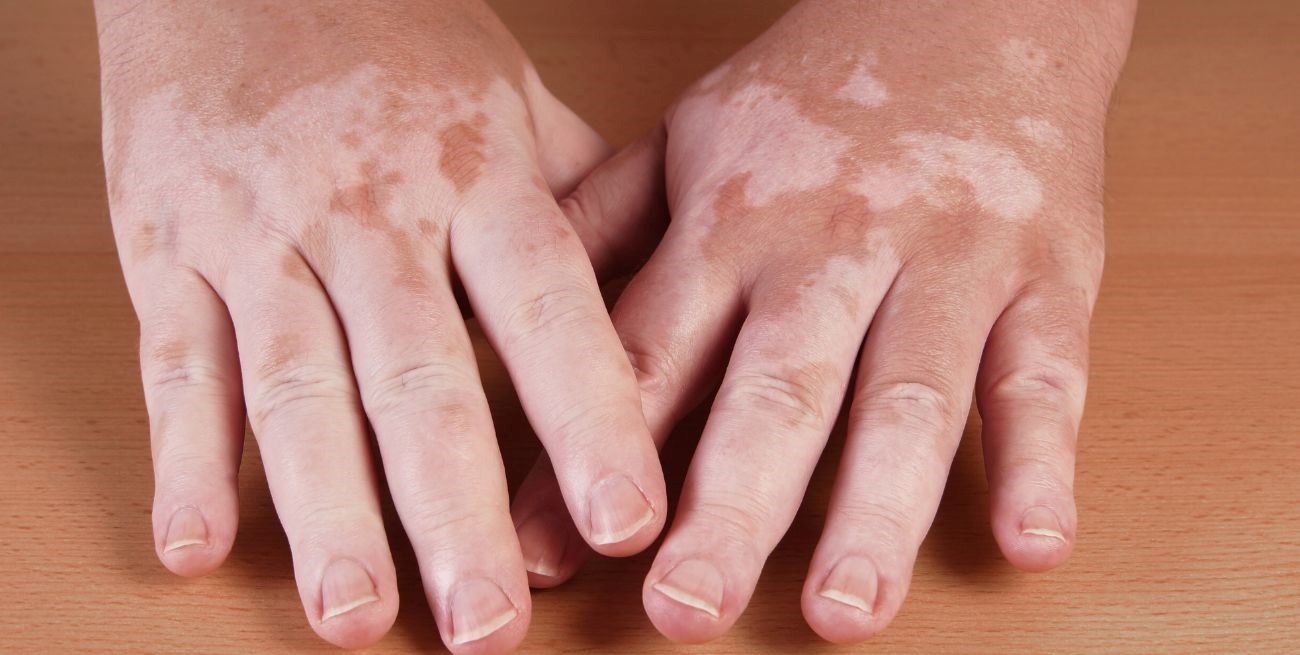 Vitiligo: qué es, cómo se trata y de qué manera afecta a quienes lo padecen