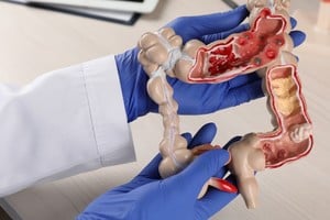 Cada año, alrededor de 16.000 personas son diagnosticadas con cáncer de colon.