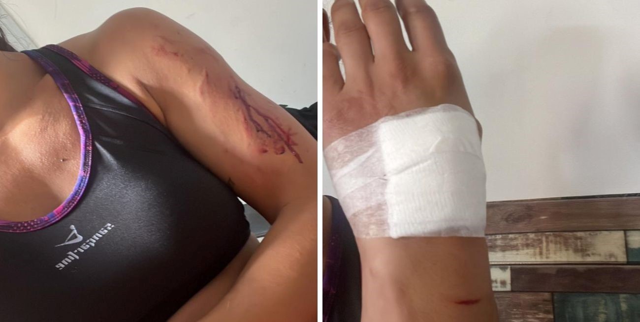 Otra mujer herida tras ser atacada por un perro tipo pitbull