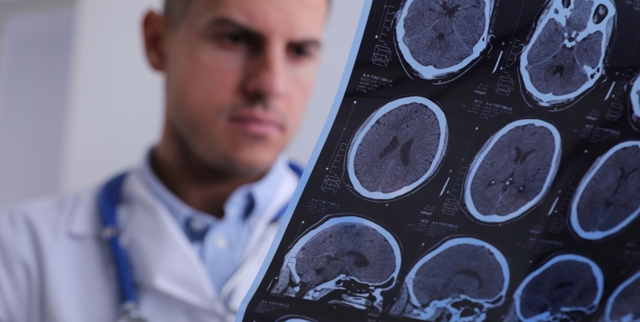 Qué es un ACV: cuántos tipos hay, cuáles son los síntomas y qué hacer si ocurre