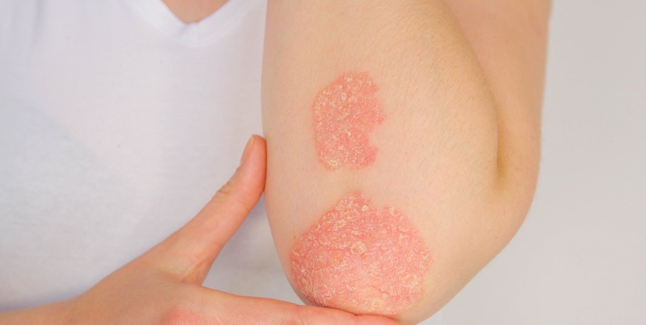 Campaña gratuita para detectar la enfermedad psoriásica: cómo y dónde acceder al diagnóstico