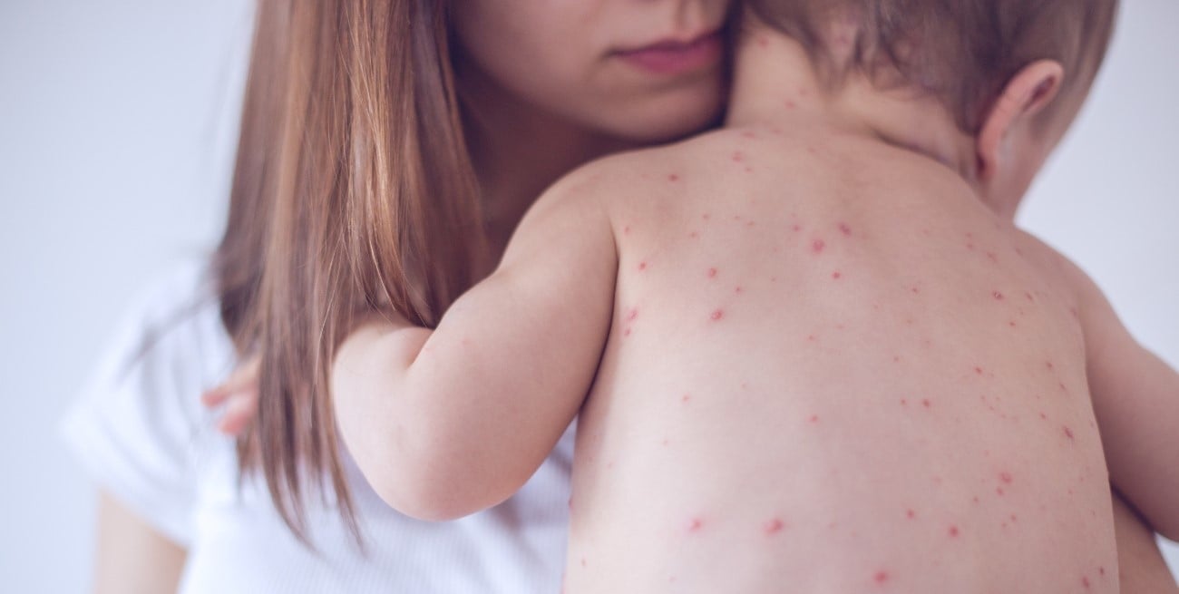 Sarampión: cómo está la situación en Argentina y por qué recomiendan reforzar la vacunación