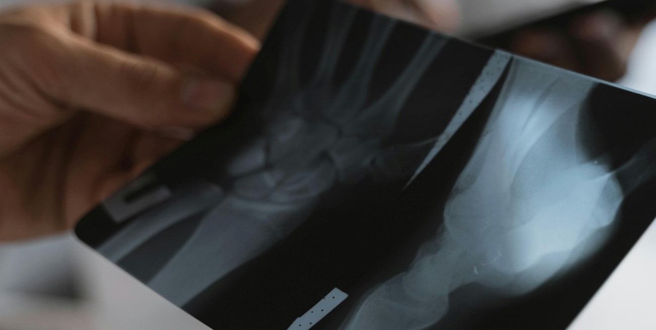 Desarrollan una pistola encoladora que podría ayudar a reparar huesos rotos