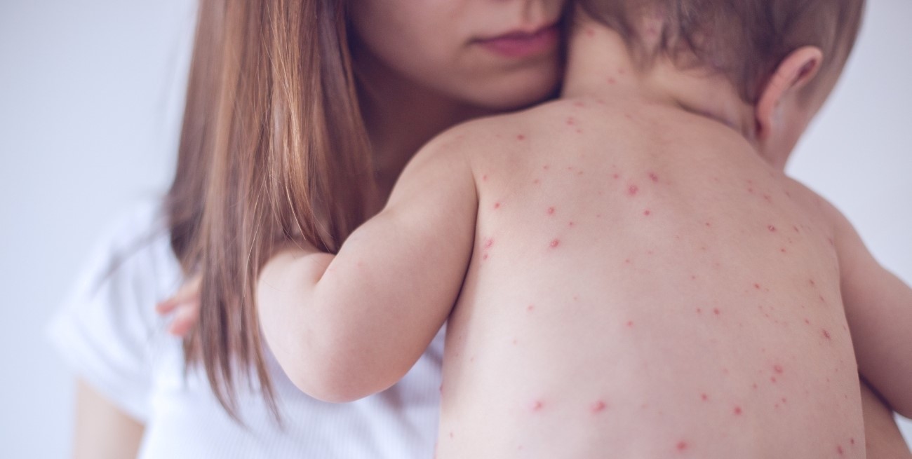 México encabeza las muertes por sarampión en América, según la OPS