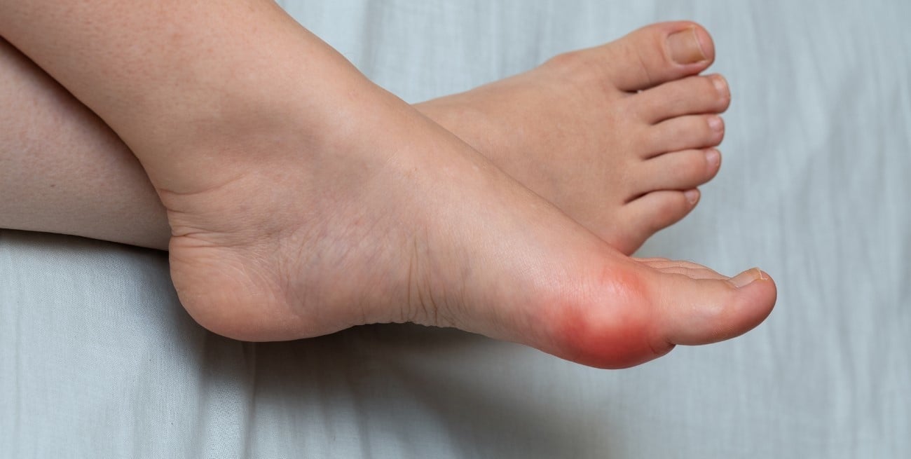Cómo cuidar los pies ante juanetes y dedos en martillo: causas, síntomas y tratamientos