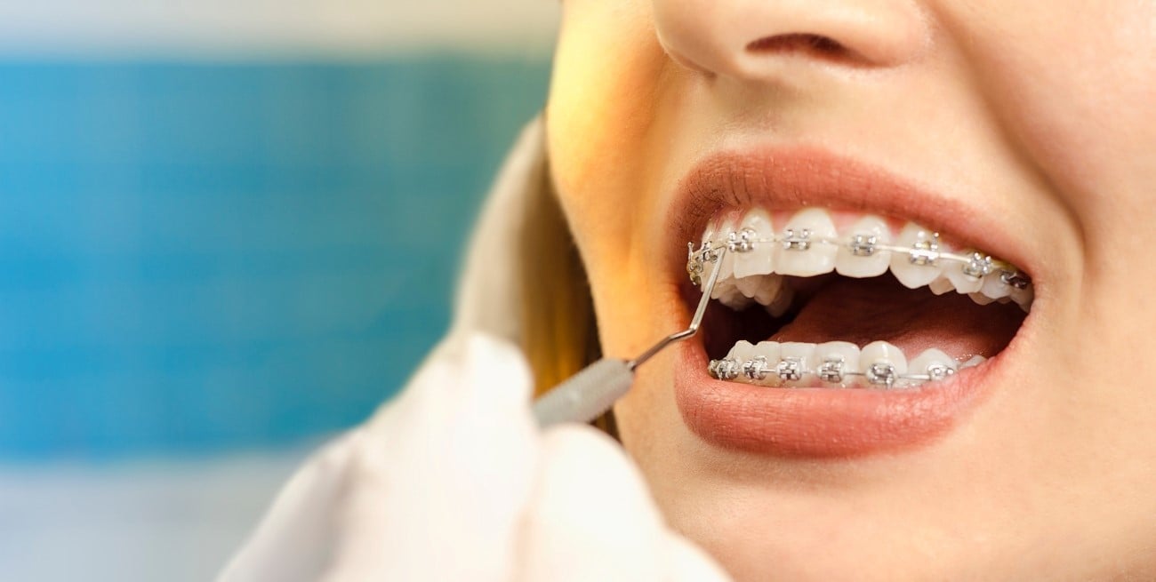 Se prohibió la venta de brackets falsificados en Argentina: riesgo para la salud dental