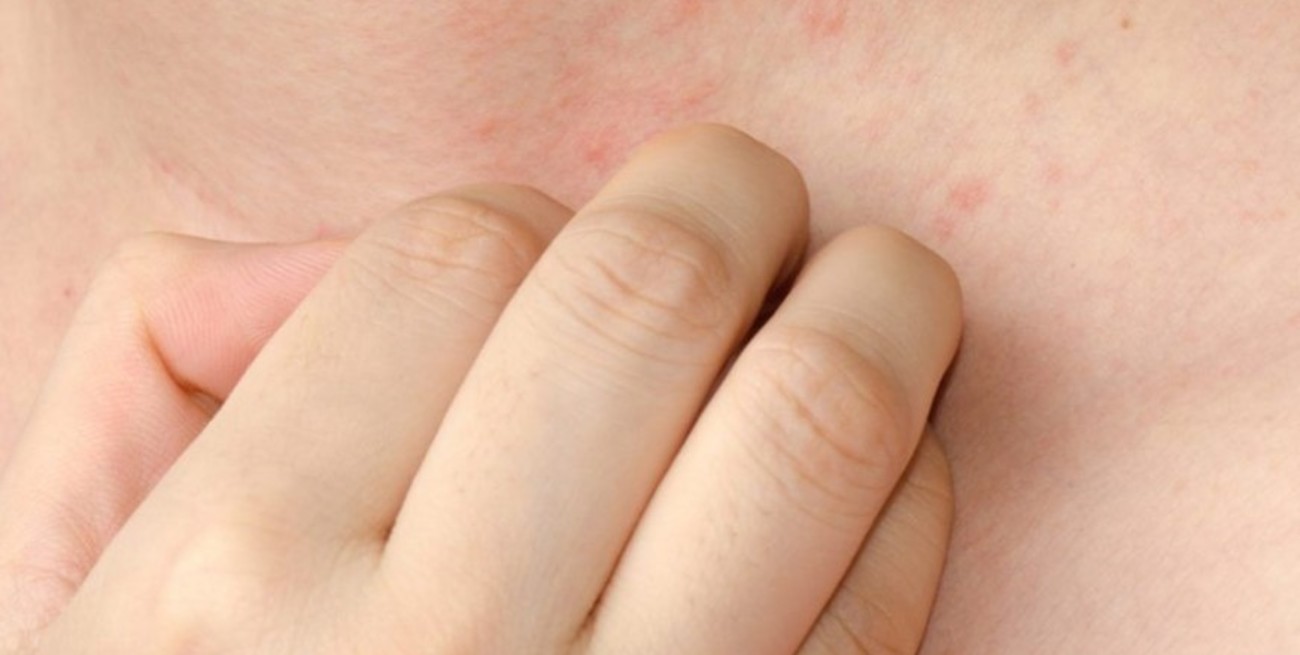 Día Mundial de la Psoriasis: concientización sobre una enfermedad que afecta a millones