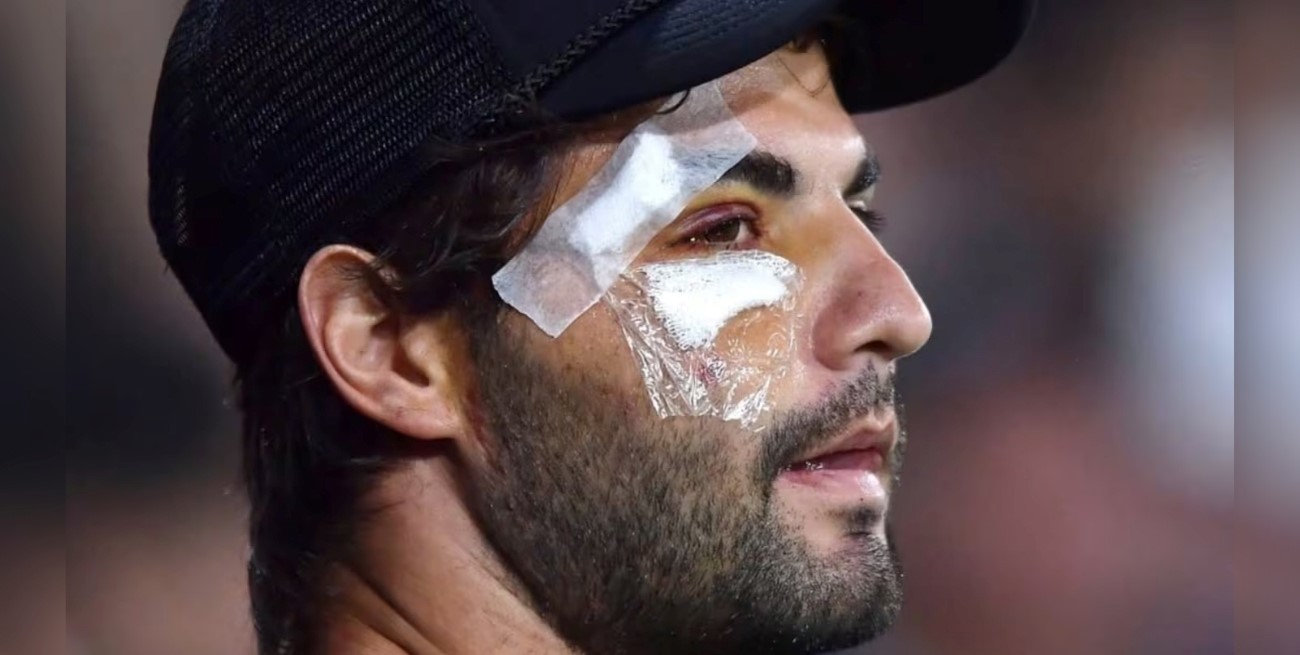 Santiago Sosa mostró su rostro tras la operación por fractura facial