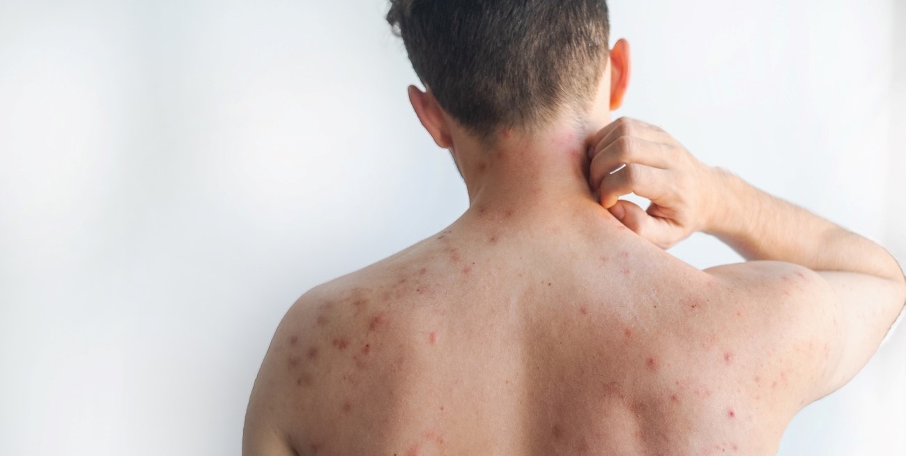 Salud alerta por la circulación de cuatro viajeros con sarampión que recorrieron varias provincias argentinas