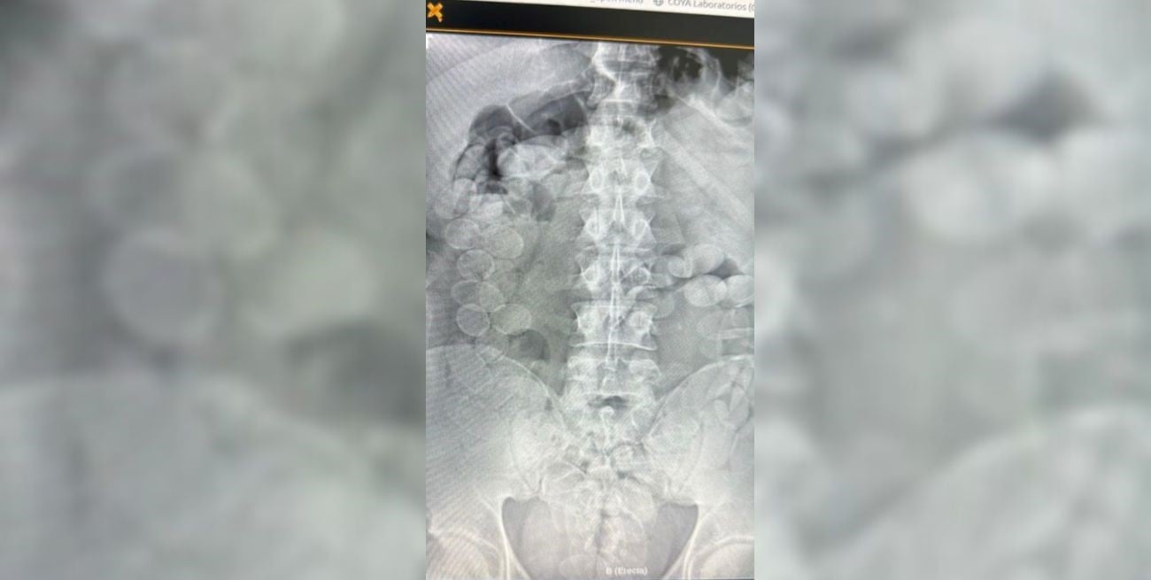 En Ceres: detienen dos "mulas" con 180 cápsulas de cocaína en sus estómagos; terminaron en el hospital  