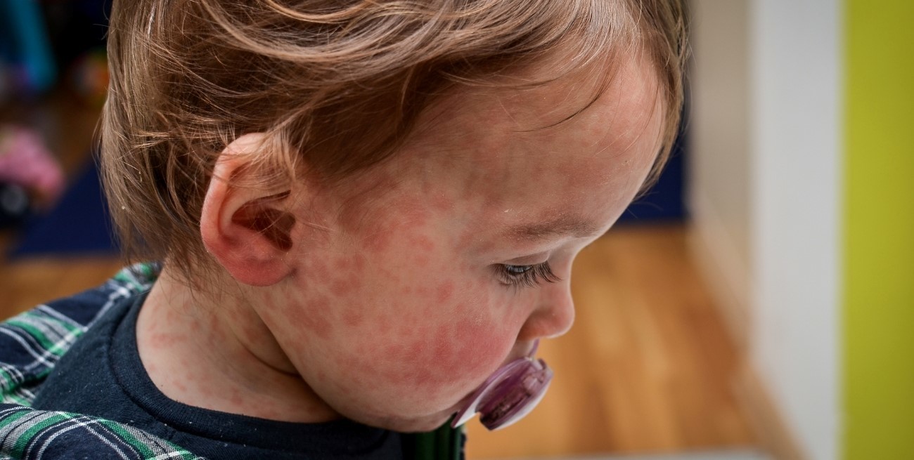 Vacunación incompleta: el factor que vuelve a poner al sarampión en escena en la región