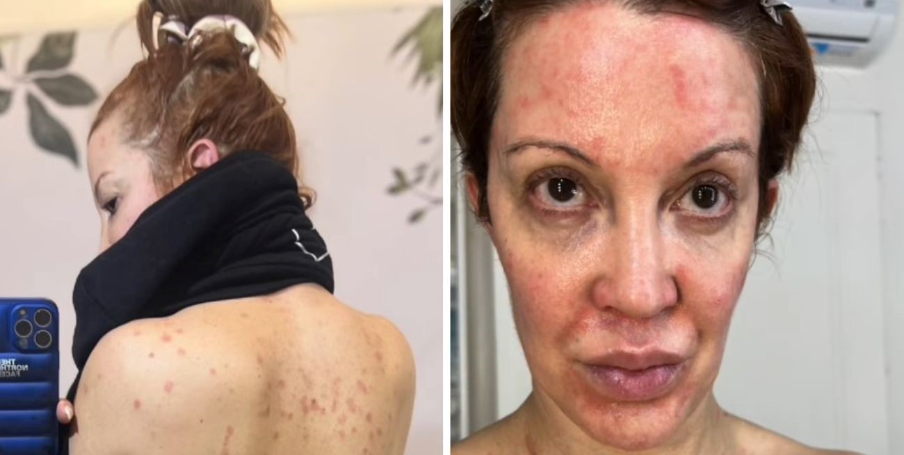 Miriam Lanzoni habló de su salud y reveló cómo la afectó la psoriasis: “Dormía envuelta en papel film”