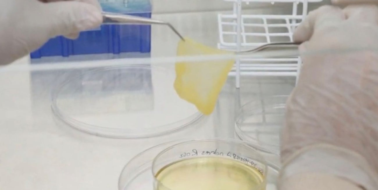 Una técnica argentina ayudó a recuperar la piel propia de un paciente después de quemaduras severas