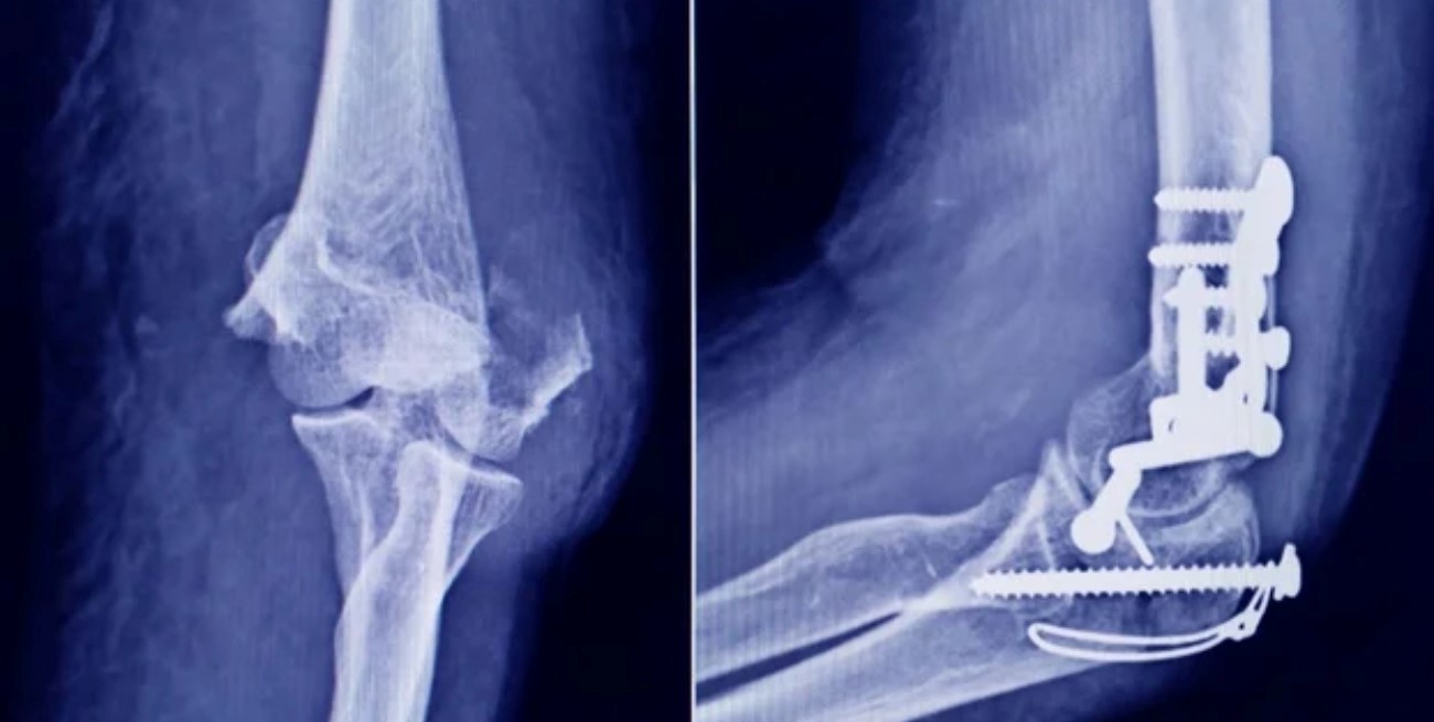 ANMAT alertó por un tornillo falsificado usado en cirugías traumatológicas