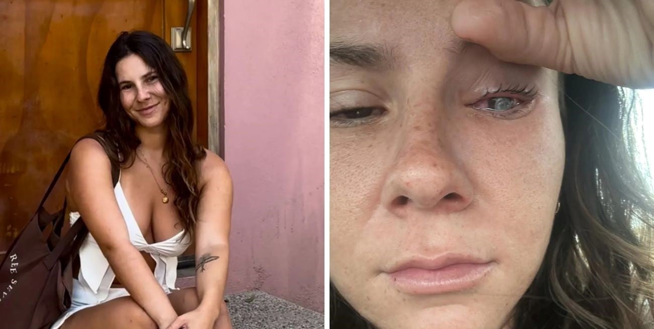 Dolor, oscuridad y miedo a quedar ciega: el calvario de una tiktoker a la que un parásito le devoró la córnea