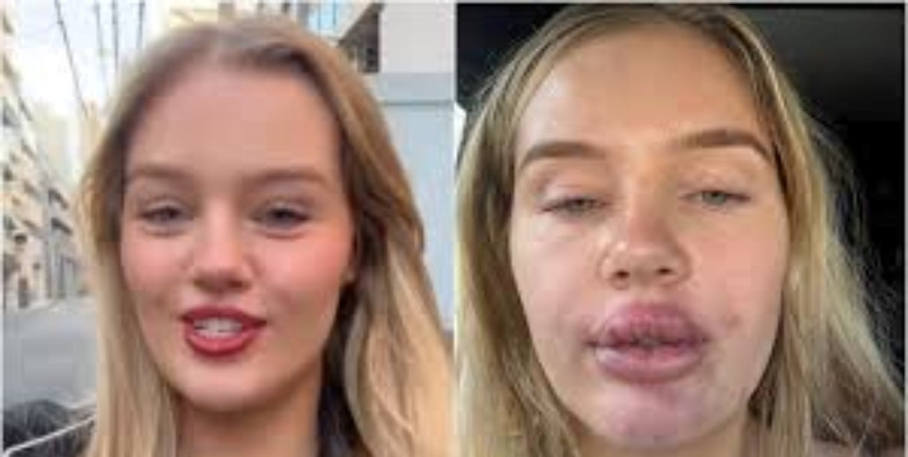 Impactante experiencia de una joven tras retocarse los labios: “Estoy asustada”