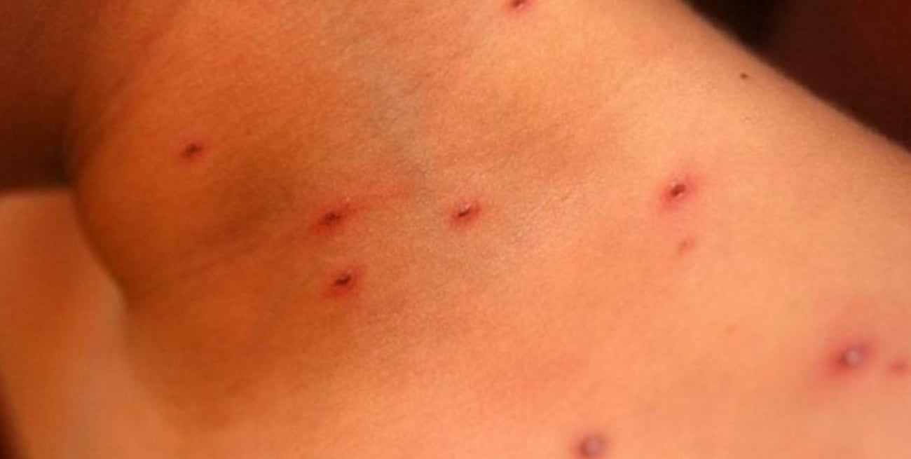 Colombia confirmó sus primeros tres casos de sarampión en los últimos cinco años