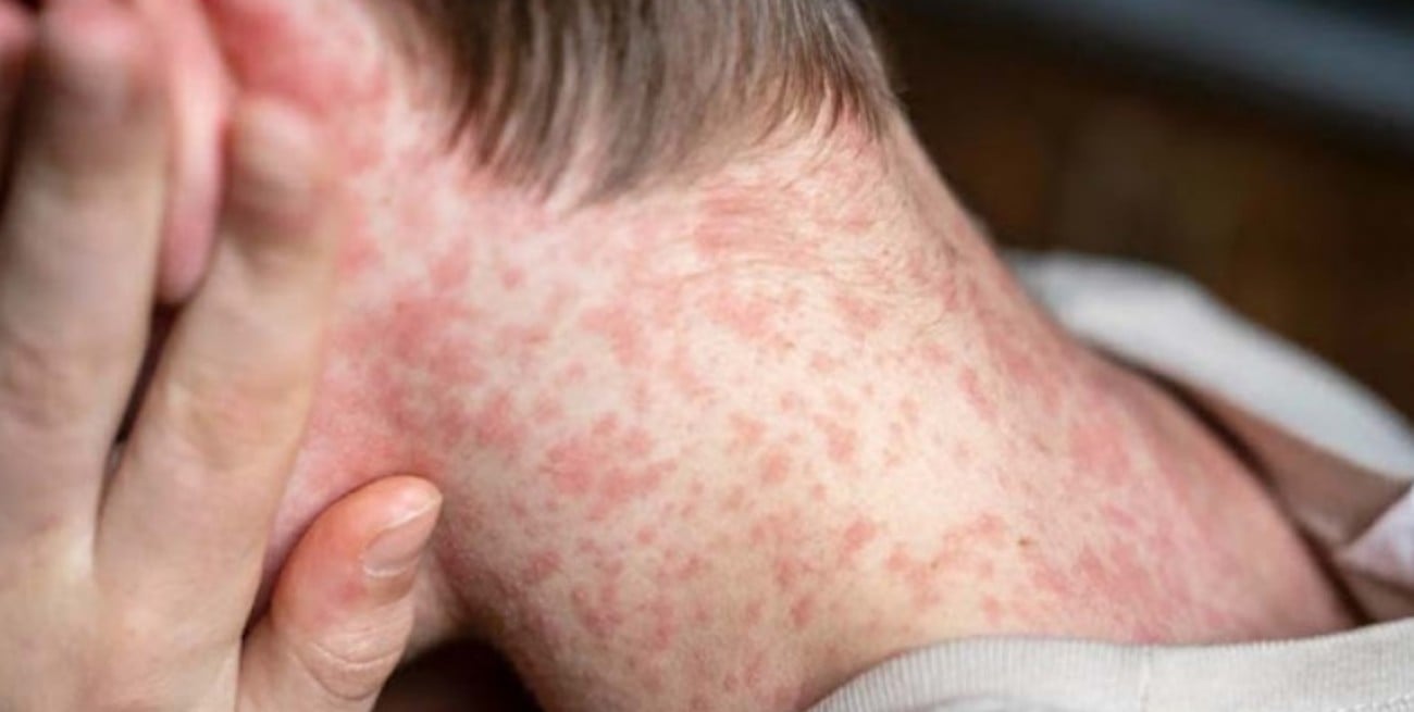 México elevó a 31 las muertes por el brote de sarampión