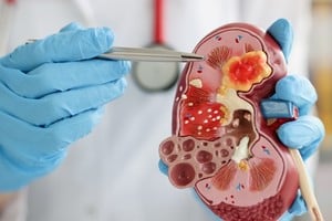 La enfermedad renal representa un problema de salud cada vez más relevante